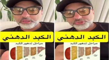 علاج الكبد الدهني: طبيب يحدد 3 مشروبات فعّالة ومدة ظهور النتائج